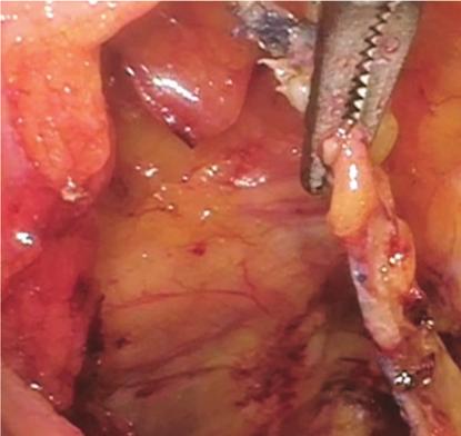 Her anterior wall prolapse and paravaginal defects were then addressed using interrupted placement of 2-0 nonabsorbable multifilament sutures for a bilateral paravaginal defect repair, which secured