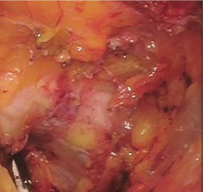 Burch urethropexy was then performed laparoscopically using CV-2 nonabsorbable polytetrafluoroethylene (Gore- Tex ) figure-of-eight sutures, placed bilaterally 1 cm lateral to the midurethra and at