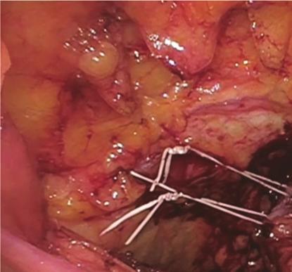 4 Case Reports in Urology Figure 4: Laparoscopic Burch urethropexy with a paravaginal repair following sling removal. Permission to reprint from Miklos and Moore.