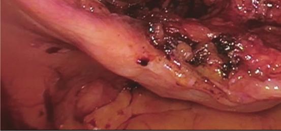 As was performed with this patient, one option to treat refractory SUI without utilizing a mesh tape sling is via concomitant laparoscopic Burch urethropexy at thetimeofslingremoval.