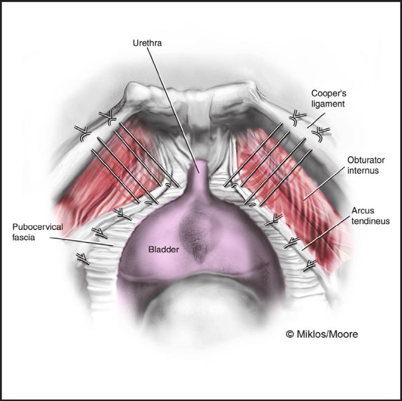 basedonourobservations,previousrpsling placement does not seem to cause as much scar tissue in the space of Retzius as a previous MMK or Burch procedure, and removal of the sling arms is relatively
