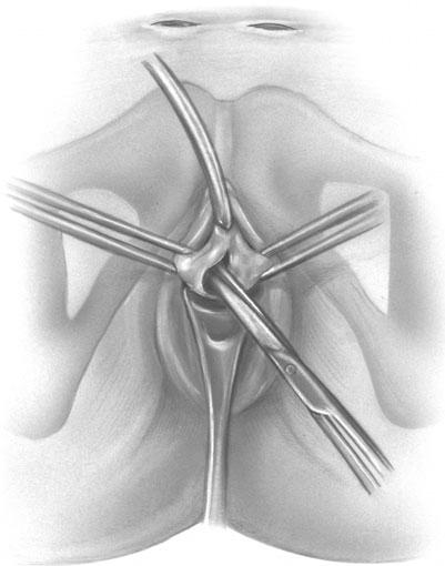 Figure 13 10 Tension-free vaginal tape (TVT) sling procedure: Vaginal dissection. Bilateral channels are created for needle insertion and mesh placement.