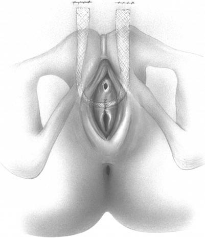 procedure uses Stamey-type Figure 13 13 Tension-free vaginal tape (TVT)