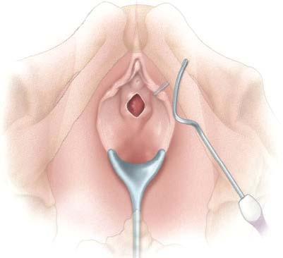 Figure 13 15 Transobturator sling procedure: Passage of needle through transobturator space.