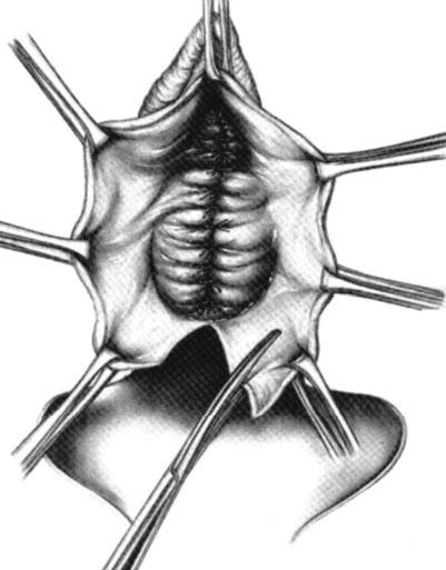 Figure 13 1 Technique of anterior repair with