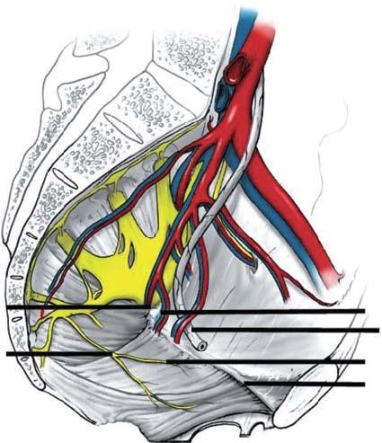 Figure 13 6 Technique of sacrospinous ligament fixation using pulley stitch to attach the vagina in the sacrospinous ligament for apical