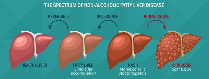 work to estimate progression rates for non-alcoholic fatty liver (NAFL) and nonalcoholic