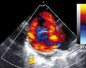 visible along with atrial