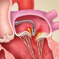 Your doctor will use imaging equipment to guide the placement of the clip. 3 Your doctor will implant the clip at the appropriate position on your mitral valve.