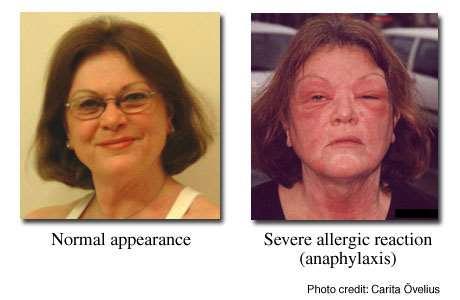 Simptomi i znaci teške alergijske reakcije