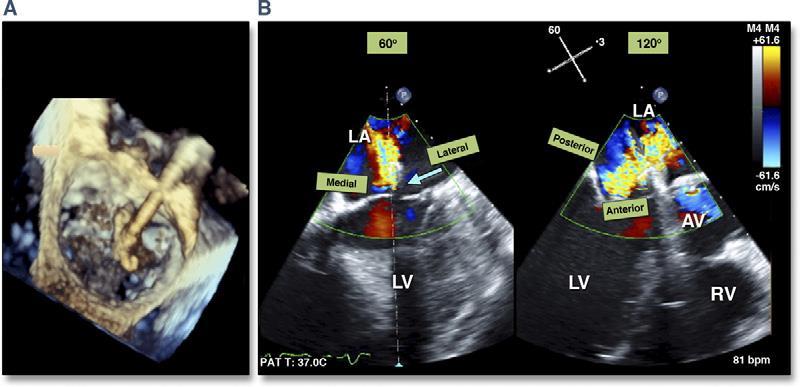 Role of Echocardiography in Percutaneous Mitral Valve Interventions Assessing the mechanism