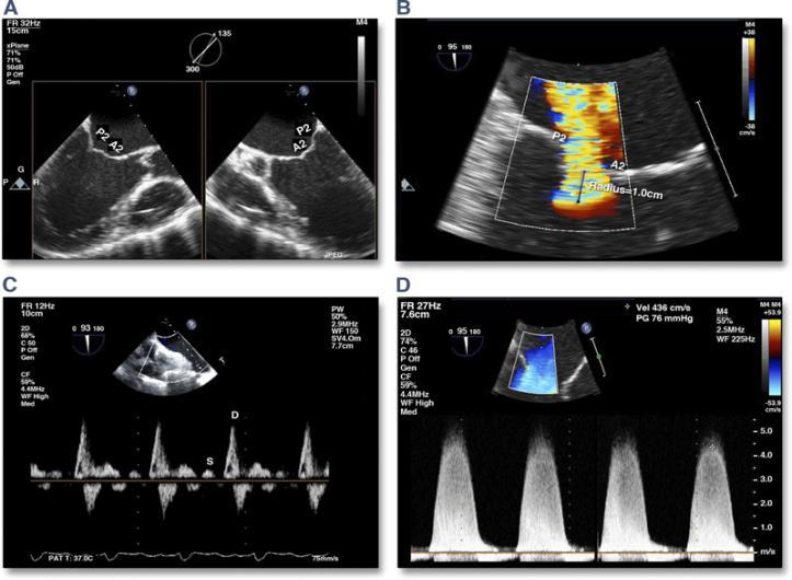 Verification of clip stability after release from delivery system Reassessing MR severity