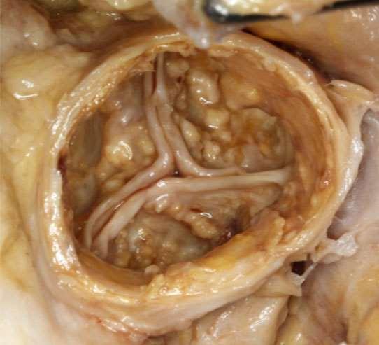 The Problem: Aortic Stenosis Gross specimen of