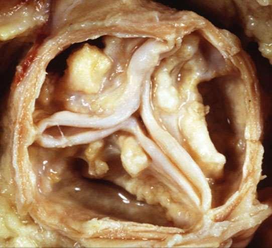 severely stenotic aortic valve (right) Images
