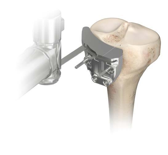 Proximal Tibial Resection After drilling the two anterior pins, the TRUMATCH Personalized Solutions Drill Guides are removed by twisting in a counter-clockwise direction, while leaving the two