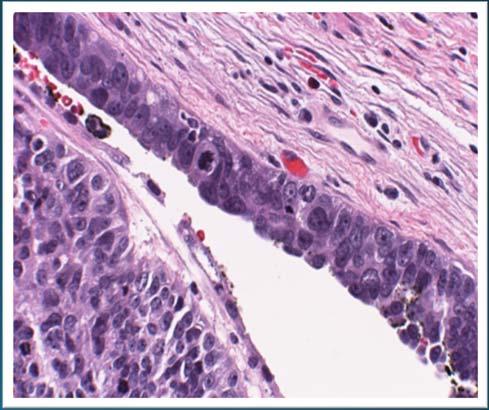 Serous Tubal Intraepithelial Carcinoma (STIC): Ovarian Cancer Precursor Type II Tumors: 70% of sporadic (non hereditary) ovarian and peritoneal high grade serous carcinomas demonstrated mucosal tubal