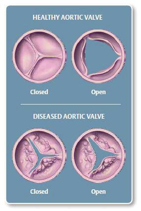 What is Aortic