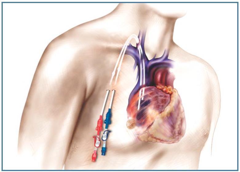 Skin tunnelled dialysis catheter (Tesio ) insertion This leaflet explains more about Tesio insertion, including the benefits, risks and any alternatives and what you can expect when you come to