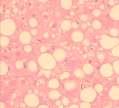 non-alcoholic) mainly macrovesicular Large droplets begin as small ones mixed patterns of droplet size common Pure microvesicular steatosis different causes & consequences Disorders of mitochondrial