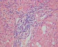 5 Portal Inflammation in NAFLD Portal/Periportal Changes in Fatty Liver Disease 1. Portal inflammation +/- interface hepatitis (chronic hepatitislike) 2.