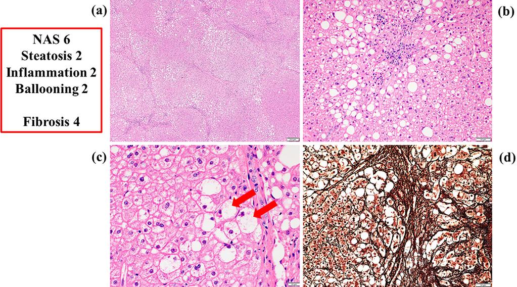 Figure 2. Histological findings of liver samples before the administration of ipragliflozin. a: An overview of the liver sample [Hematoxylin and Eosin (H&E) staining, 50 ].