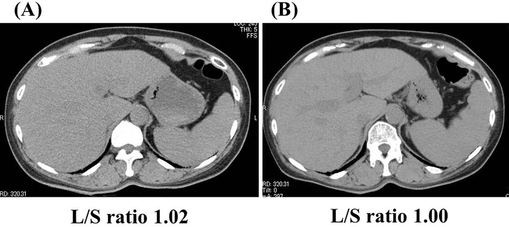 Figure 4. Computed tomography of the liver. Before (A) and two months after the administration of ipragliflozin (B). L/S ratio: liver-to-spleen ratio Table 2.