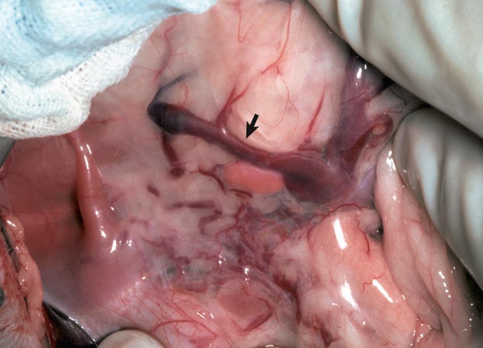 single vessel connecting the portal vein to the caudal vena cava or the azygous vein Most often small breed dogs
