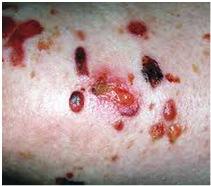 Toxicities: Rash Maculopapular Papulopustular Bullous Pemphigoid 20-40% Patients with anti-pd-1 Rarely serious, <5% Tx d/c rate Antibody mediated (against BP180) Also found on melanomas Management: