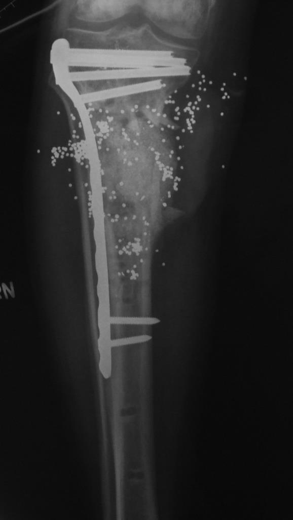 Internal fixation Removal medial