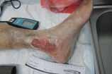 Patient DEA001:chronic venous leg ulcer Patient is a 70-year old male with a history of chronic venous ulceration.