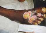 Patient DEB003: burn wound diabetic patient A 44-year old type 1 diabetic patient with a history of a nonhealing deep partial thickness burn wound.
