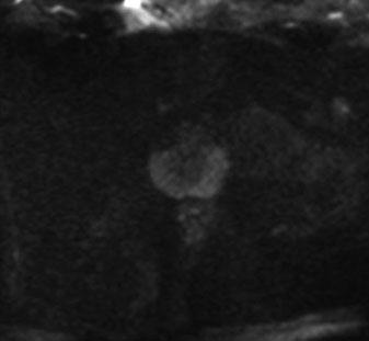 DTI of normal prostate at 3 T (a) (b) (c) (d) (e) (f) Figure 1.