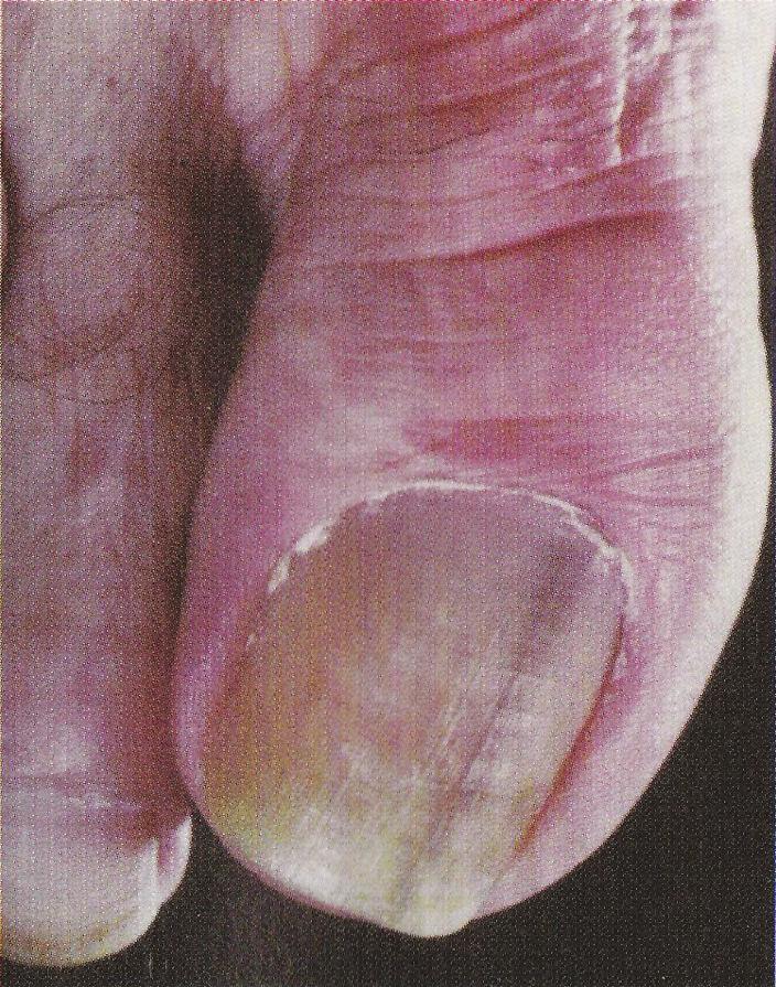 NAIL STREAKS ma and have a higher incidence of melanonychia striata. Some authors have linked trauma and friction in both the causes of melanonychia striata and subungual melanoma.