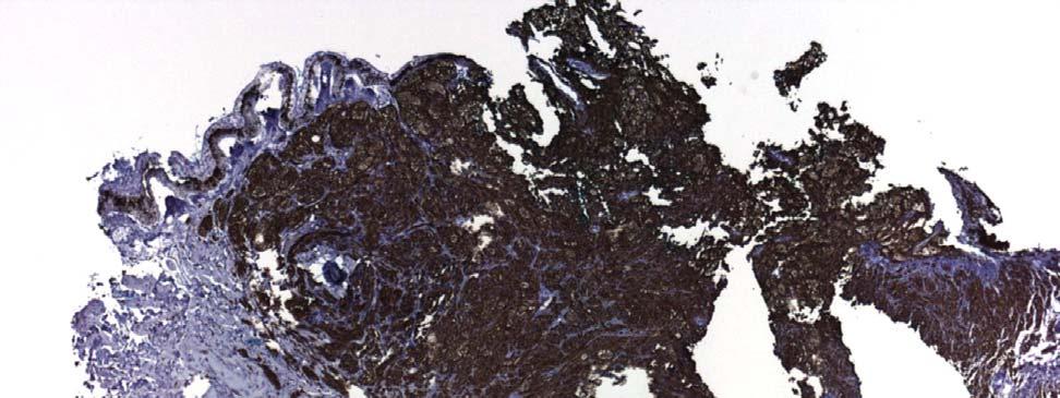 Figure 8: MART-1 (Melanoma Antigen Recognized by T-cells) stain: Positive brown staining of the lesion confirms the diagnosis of melanoma. Note the positive margins on the specimen.