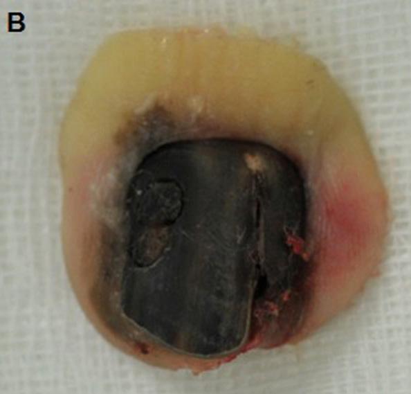 (D) Granulation tissues were sufficiently formed during a secondary healing period of 34 days after wide excision. (E) Skin graft was subsequently performed.