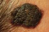 Seborrheic Keratosis vs. Melanoma In which patient(s) are you worried about melanoma? A. 65 yo male.