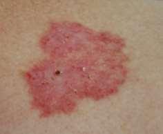 Telangectasias Nummular eczema Extremities Pruritic Often