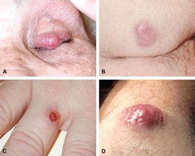 MERKEL CELL CARCINOMA (photos previously published in the Journal of the American Academy of Dermatology, 2008