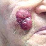 Merkel cell carcinoma (MCC) Rare (~1500 cases per year, most age 50+) Caused by a virus Can occur anywhere, sun-exposed sites common Skin, mouth, genitals; ~50% head and