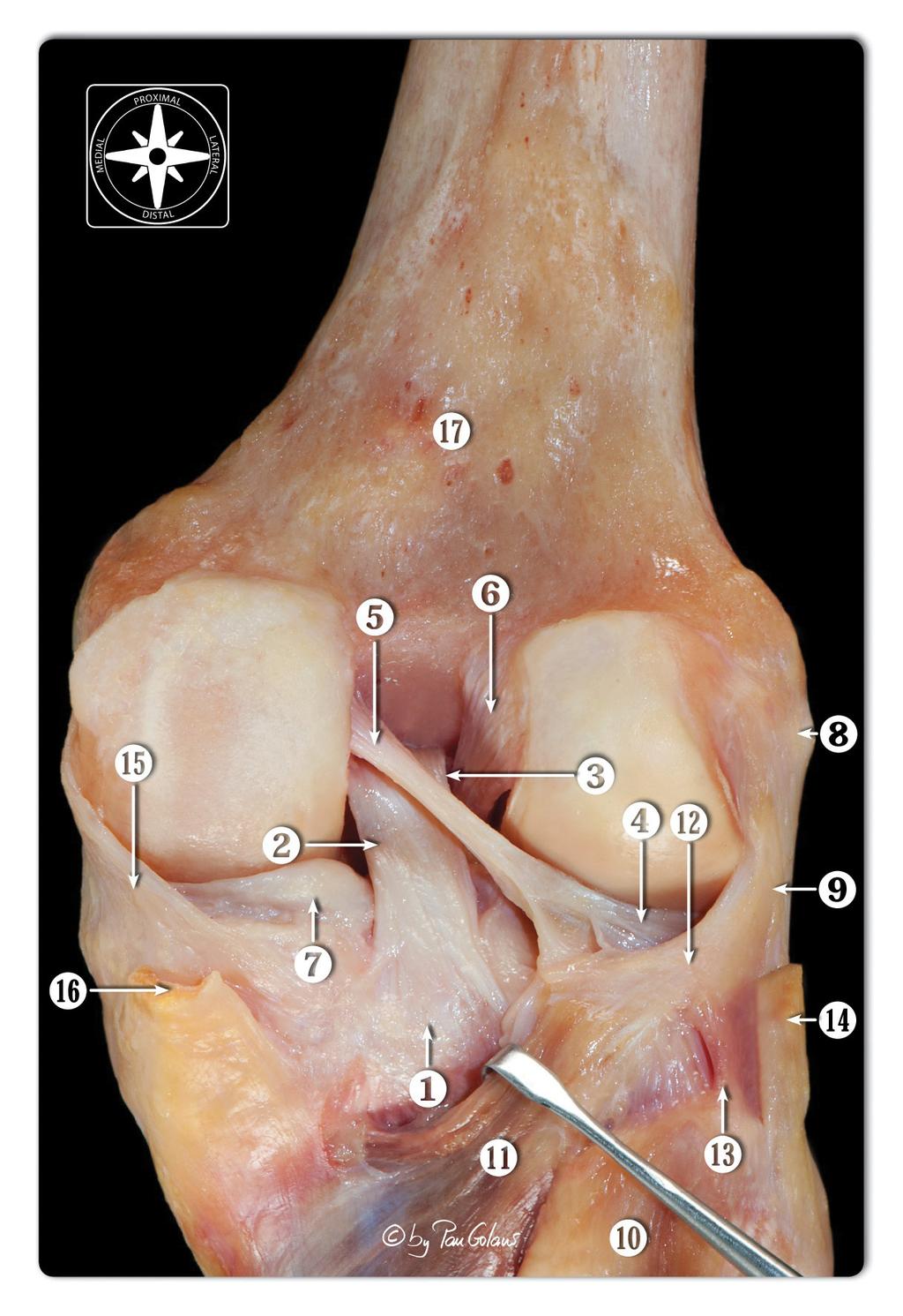 5=coronary ligament (meniscotibial capsule), 6=anterior horn of the medial meniscus, 7=lateral epicondyle, 8=lateral collateral ligament, 9=medial epicondyle, 10=medial collateral ligament,