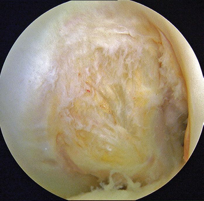 ranging from 7 to 10 mm from the posterior edge of the PCL. Femoral insertion The femoral insertion of the PCL on the medial femoral condyle has a semi-circular appearance (Figure 3).