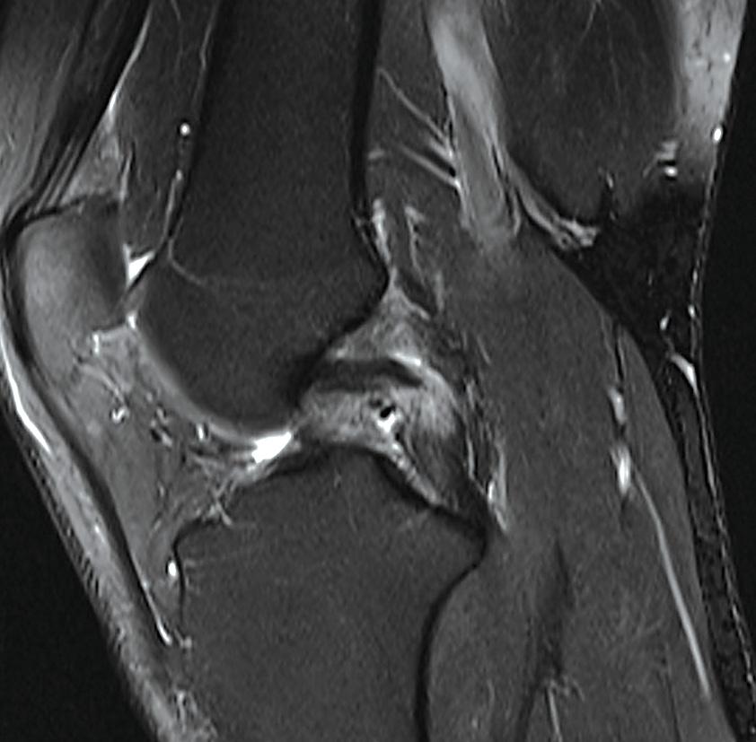 Figure 10: MRI showing a partial tear of the posterior cruciate ligament.