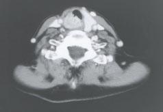 ination or with symptoms suggesting intraluminal invasion (eg, hemoptysis or stridor) can undergo a contrastenhanced CT scan or MRI to assist with surgical planning (Figs 2-3).
