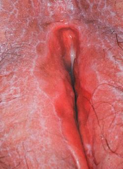 Erosive lichen planus of the vulva with