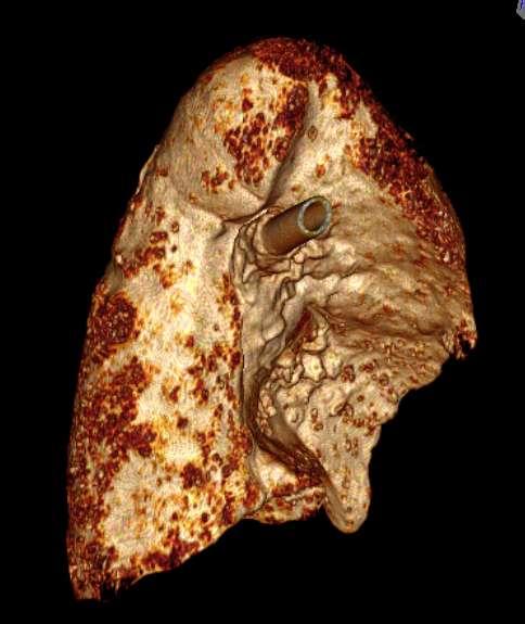 Frozen Lung Reconstructed 3D image