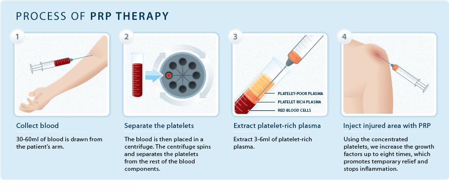PRP DEFINITION=Plasma product containing a platelet