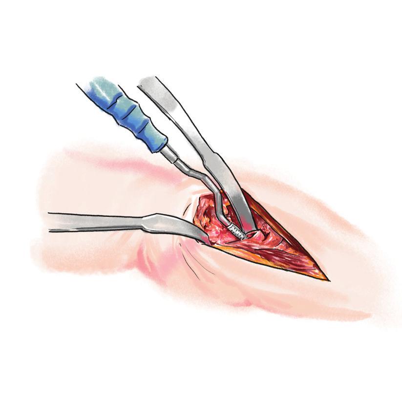 Opening the Femoral Canal Use a gouge, then the Modular Box chisel from the Furlong Evolution set, to remove bone in the supero-lateral region of the neck.