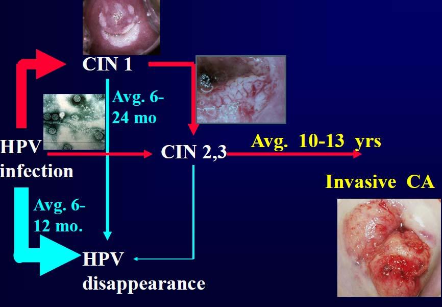 Natural History of Cervical Cancer ~ 90 % HPV infections are transient.