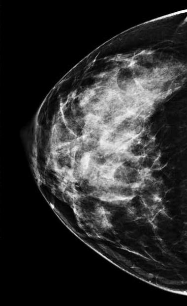 4% in next 5 years for woman 50-54 years Tice, Ann Intern Med, 2008; Tice, JCO, 2015 Mammography Strategies Age 40-49