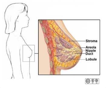 Breast Cancer: Overview Solid tumor arising